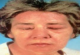 DE BETROKKENHEID VAN NF-κB IN IDIOPATHISCHE INFLAMMATOIRE MYOPATHIEEN VS.  DUCHENNE MUSCULAIRE DYSTROFIE