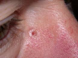 Very rarely, basal cell carcinoma may spread (metastasize) to nearby lymph nodes and other areas of the body. Basal Cell Cancer Article
