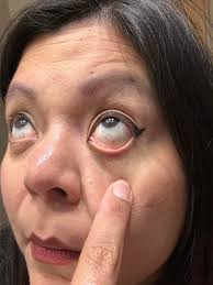 Why does my eye crease so badly?