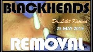 Blackheads & milia, big cystic acne blackheads extraction whiteheads removal pimple popping part42. Blackheads Removal By Dr Lalit Kasana 25 May 2019 Youtube