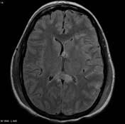 Image result for Diffuse Axonal Injury