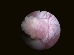 The dogs were examined cytoscopically at frequent intervals. Bladder Tumor An Overview Sciencedirect Topics