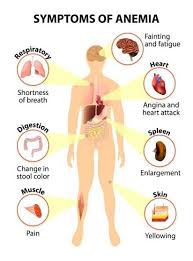 Image result for Anemia simii