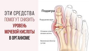 как понизить мочевую кислоту в крови в домашних условиях Vot Kak Izbavitsya Ot Mochevoj Kisloty I Vylechit Podagru 10 Dostupnyh Sredstv Life Advice Health Beauty Health Fitness