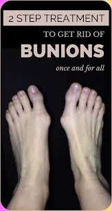 Here Is How To Get Rid Of Bunions Completely Natural Get Rid Of Bunions Bunion Treatment Bunion Remedies