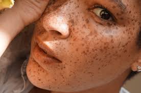 how to hide freckles makeup saubhaya