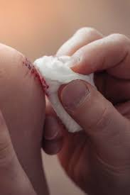 Avoid cotton swabs, as the honey may pick up the small fibers and deposit them on the scab. How To Get Rid Of Scabs Fast