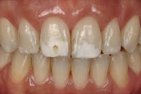 Over 10 million people worldwide have beautified their smile with invisalign. Treatment Of Extensive White Spots By Resin Infiltration Styleitaliano Org