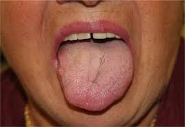 Isolated Hypoglossal Nerve Paralysis And Hypoglossal Vertebral Entrapment Syndrome Springerlink