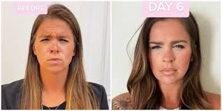 We did not find results for: Woman Takes Photo Every Day Revealing How Long It Takes For Botox To Work