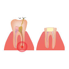 However, there is always a risk of infection after a root canal procedure. Root Canal Infection Symptoms Queens Ny