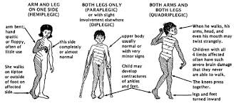Cerebral Palsy Introduction Physiopedia