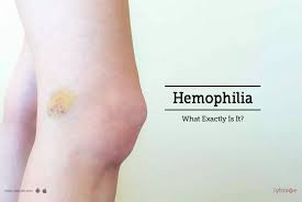 Dr Ankur Mittal Book Appointment Consult Online View Fees Contact Number Feedbacks Hematologist In Ludhiana Hematologist Hemophilia Hereditary