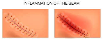 3 Ways To Know The Difference Between Healing And Infected Surgical Wounds Dr Grazer