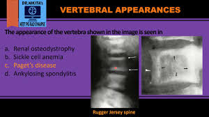 Picture Frame Vertebra Pagets Disease Youtube