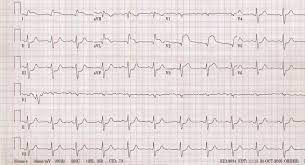 Najčastejšie ekg znaky pri pľúcnej embólii: Plicni Embolie Ekg Shefalitayal