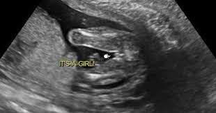 Boy Or Girl Ultrasound Wrong Gender Scan Accuracy Boy Ultrasound Boy Or Girl Prediction Ultrasound Gender Prediction