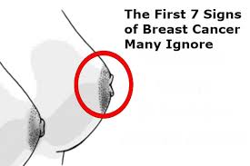 The major categories are the histopathological type, the grade of the tumor, the stage of the tumor, and the expression of proteins and genes. The First 7 Signs Of Breast Cancer Many Ignore The Planet Today News From The World
