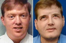 Now I don't have to worry about people staring': Firefighter's  extraordinary face transplant