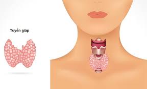 0, 1, 2, 3a, 3b, 4 các liệu pháp này không giúp chữa khỏi ung thư hoàn toàn nhưng có thể hỗ trợ kiểm soát khối u và làm giảm triệu chứng giúp người bệnh thường có tiên lượng tốt nên có thể sống lâu. Bá»‡nh Nhan Ung ThÆ° Tuyáº¿n Giap Sá»'ng Ä'Æ°á»£c Bao Lau Hoibenh Com