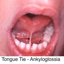 Image result for Ankyloglossia