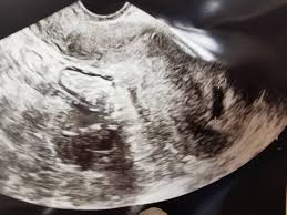 Leere Fruchthohle In Der 7ssw Erster Kinderwunsch