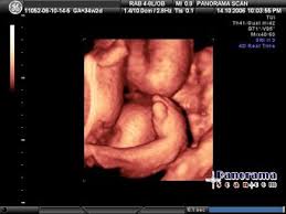 Many parents find out their child has clubfoot during a prenatal ultrasound months or weeks before their child is born. 404 Not Found Ultrasound Sonography Ultrasound Sonography