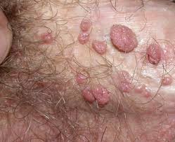 Image result for genital warts
