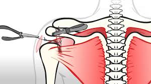 Serious and debilitating complications developed if the deltoid muscle origin did not heal back to the acromion, so surgeons now will now access the rotator cuff tear by leaving the deltoid muscle attached and simply splitting it (like 'peeking through closed curtains') to gain access to the rotator cuff where it attaches to the humerus. Regenexx Procedures For Shoulder Injuries And Arthritis Stemcell Arts