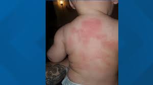 Rash On Baby With Coronavirus Could Be Another Disease Wtsp Com