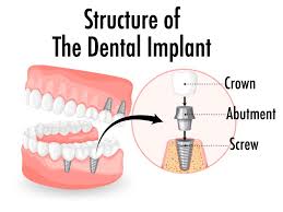 Image result for dental implant