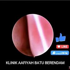 Apakah punca selsema dan bagaimana cara hilangkan selsema? Selsema Berpanjangan Klinik Aafiyah Batu Berendam