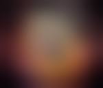 Image result for conjunctival melanoma