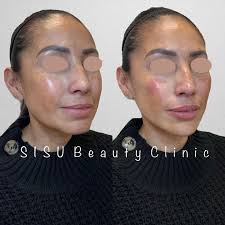 Half syringe of filler can add volume...