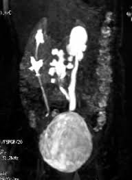 Mri Showing Bilateral Duplex Collecting System With Double Ureter And Download Scientific Diagram