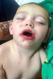 Both types of herpes simplex virus produce 2 kinds of infections: Toddler Left Covered In Angry Rash After Catching Herpes From Her Dad Who Had A Cold Sore