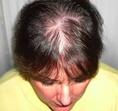 Very low levels of granulocytes, a type of white blood cell. Faq S Drugs That Cause Hairloss Ace Wigs The Original Wig Site