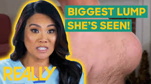 Dr. Lee Removes The BIGGEST Lump She’s Ever Seen! I Dr. Pimple Popper