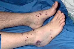 A purpuric rash is not a disease but it is caused by conditions that result in blood leaking into the skin and other body surfaces. Iga Vasculitis Henoch Schonlein Purpura Vasculitis Uk