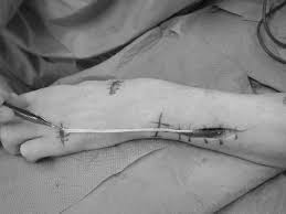 Learn vocabulary, terms, and more with flashcards, games, and other study tools. Harvest Of The Extensor Digiti Minimi Edm Tendon From The Fifth Download Scientific Diagram