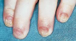 Image result for Paronychia feet