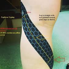 Our Kt Tape Popliteus Muscle Taping Position With Effected Leg Straight And Toes Pointed Inward Place Tape As Noted In Kt Tape Meniscus Tear Kinesio Taping
