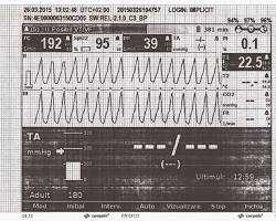 Image of Tahicardie ventriculară EKG