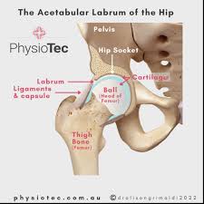 Image result for Hip Labral Tear