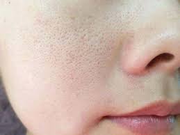 *cuci muka penting utk refresh muka dan hilangkan kotoran yg lekat pd wajah, barulah kulit boleh bernafas.kalau tbersih,liang roma akan tersumbat dan halang kalau nak apply just madu sahaja atas kulit pun boleh. Pori Pori Besar Jadikan Kulit Wajah Nampak Bermasalah Atasinya Dengan Lemon Dan 5 Bahan Yang Lain Keluarga