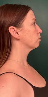 I give up : r/jawsurgery