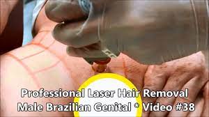 Webmd explains laser hair removal, including costs, benefits, and side effects. Professional Laser Hair Removal Male Brazilian Genital Video 38 Youtube