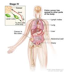 Cancer that starts in the lymph nodes is called lymphoma. How We Diagnose Colon Cancer Dana Farber Cancer Institute Boston Ma
