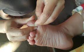 Use a small needle to remove the splinter. What Happens If You Don T Take Out A Splinter Live Science