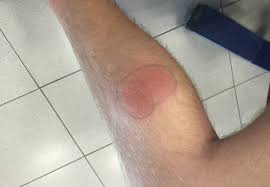 Det er en sykdom som det er vanlig at utslette etter hvert får en avblekning i sentrum. Flattbitt Borrelia